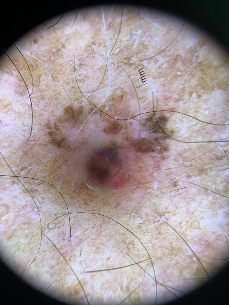 Dermatoscopia no câncer de pele.