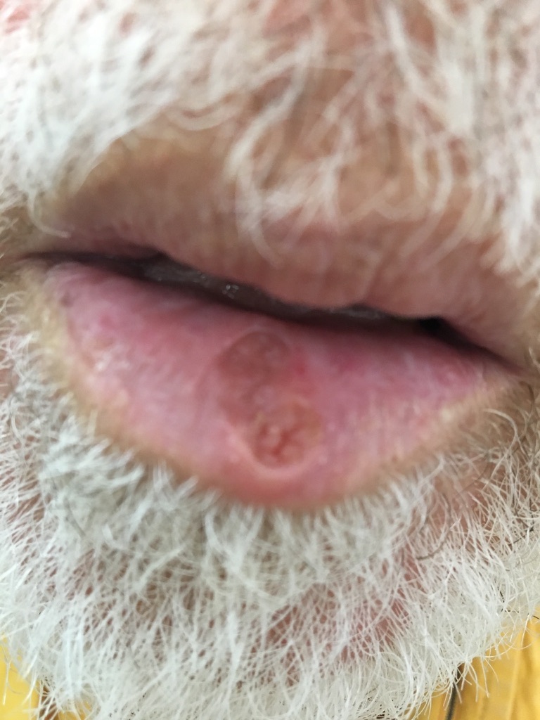 câncer de pele. carcinoma espinocelular