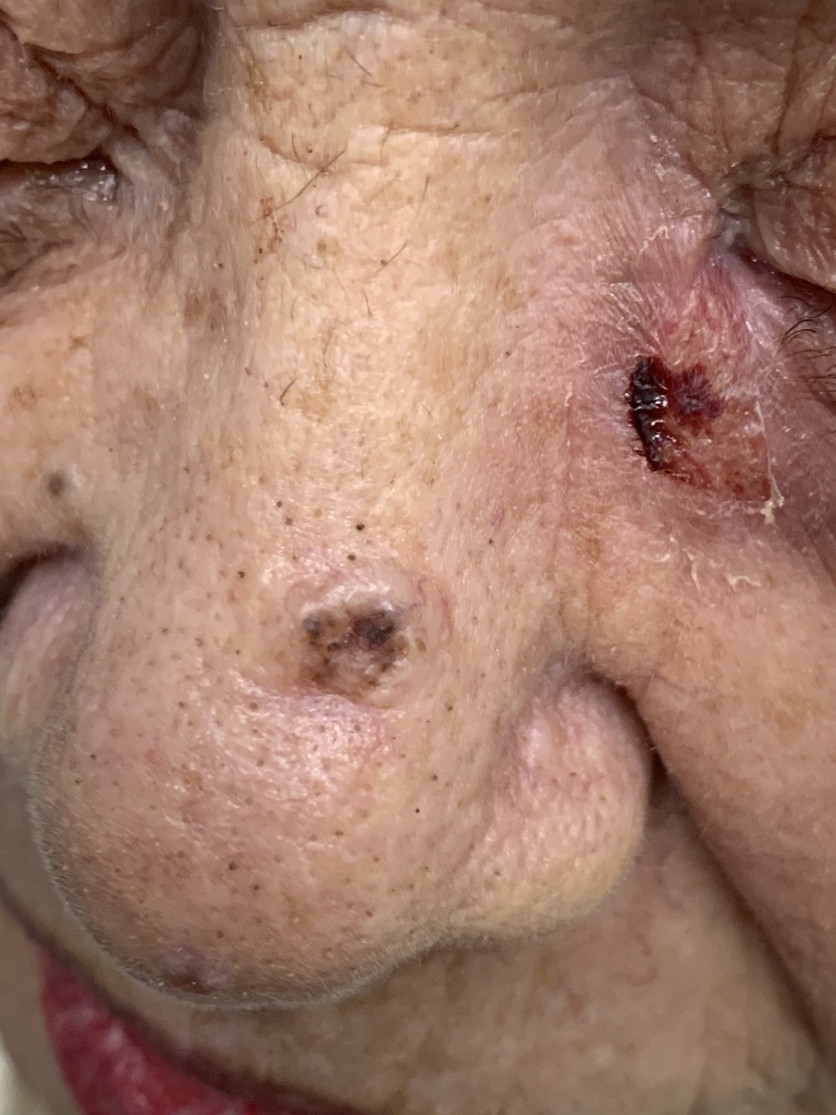 cancer de pele. carcinoma basocelular
