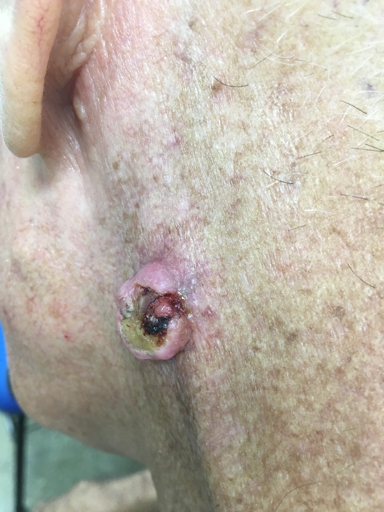 câncer de pele. Carcinoma espinocelular