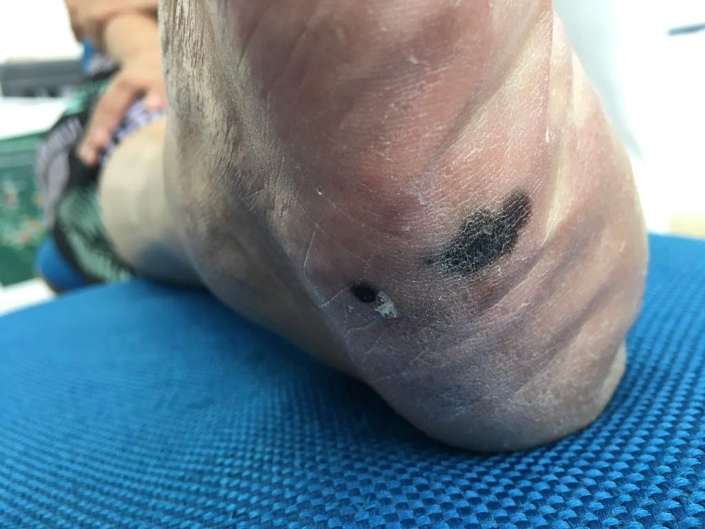 câncer de pele. Melanoma.
