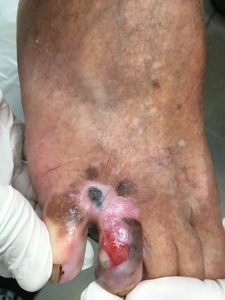 câncer de pele. Melanoma