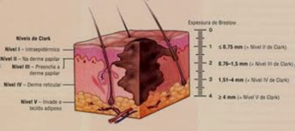 câncer de pele melanoma. Niveis de Clark e Breslow