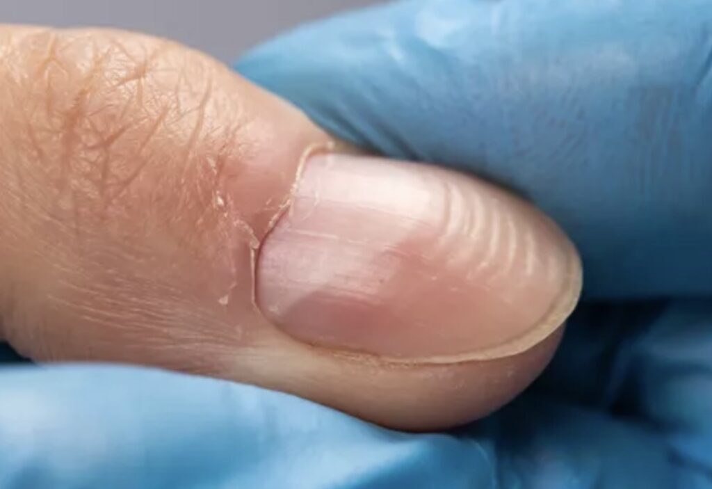 Câncer e Pele: unhas de beau