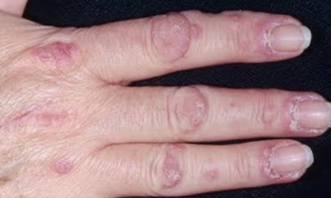 Câncer e Pele: dermatomiosite