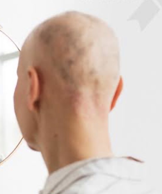 Câncer e Pele: alopecia da quimioterapia