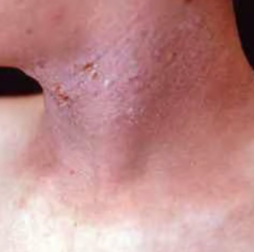 Câncer e Pele: dermatite fissurada