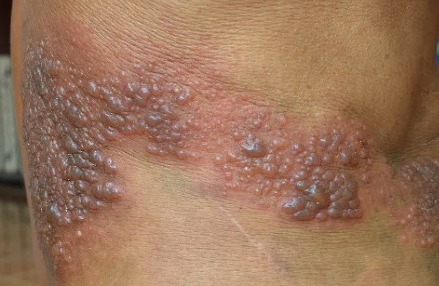 Câncer e Pele: herpes zoster