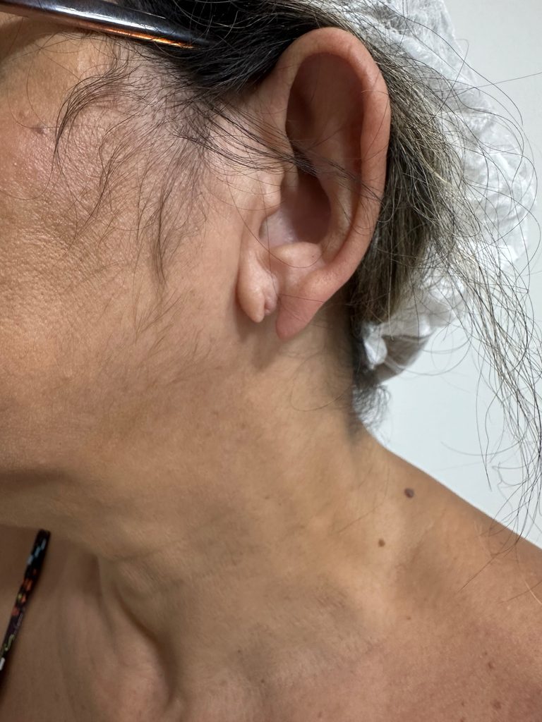 Lóbulo da orelha rasgado em dois lugares